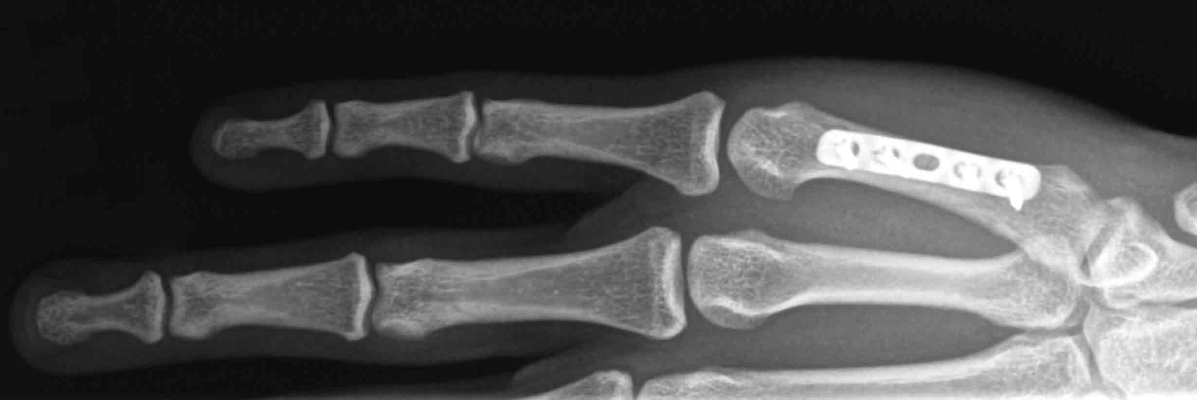 Common hand fractures